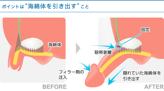 長茎概要図