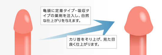 亀頭増大・亀頭強化治療